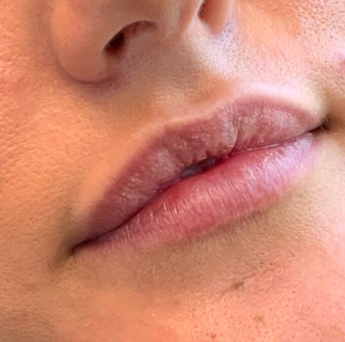 Lip Filler Before & After Image