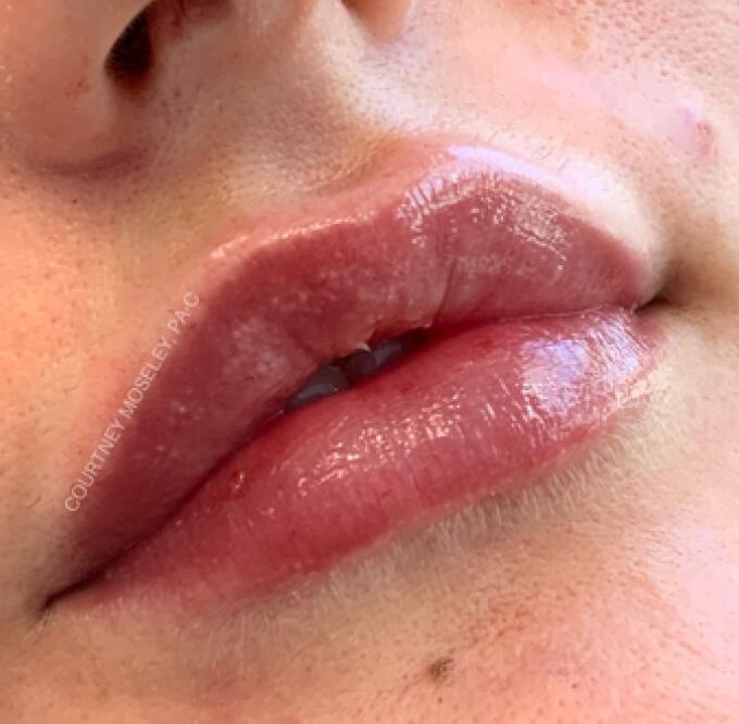 Lip Filler Before & After Image