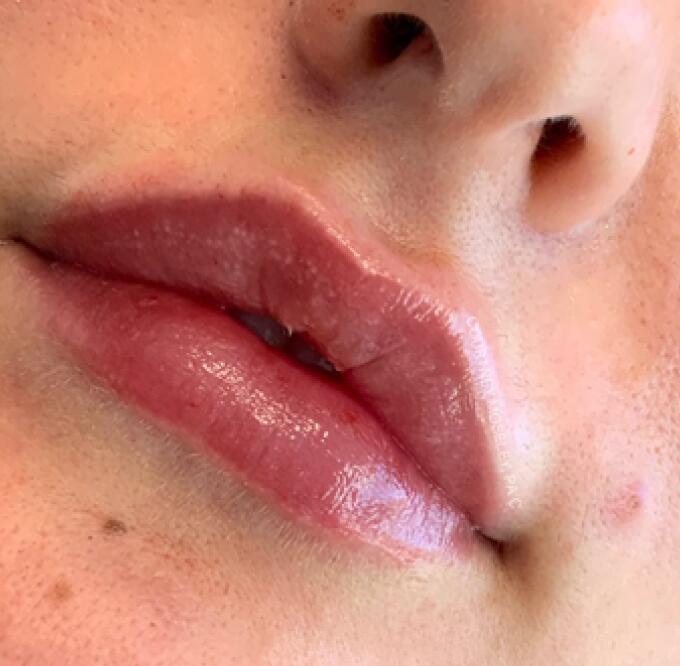 Lip Filler Before & After Image