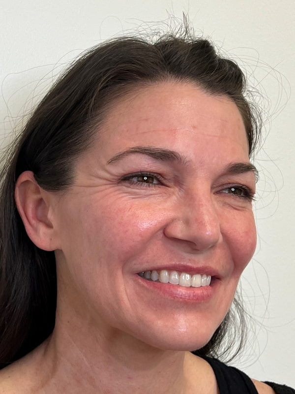 Botox/Dysport Before & After Image