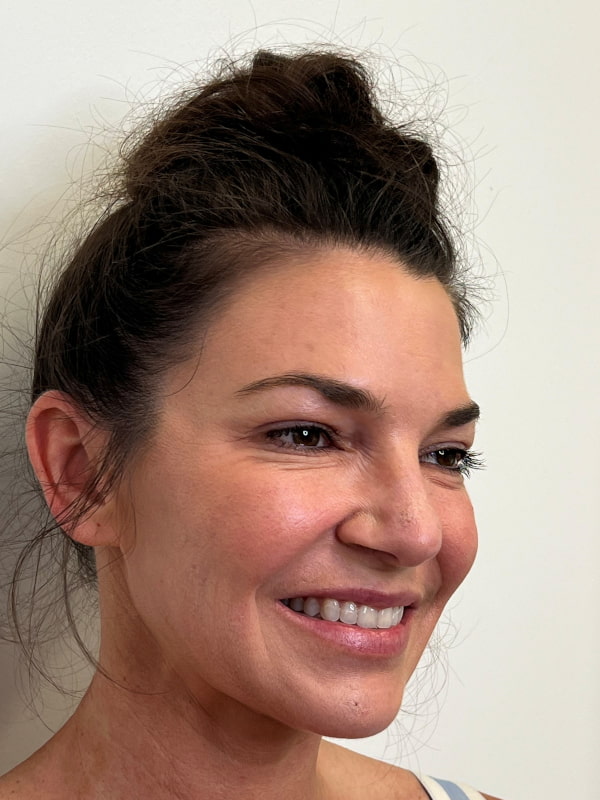 Botox/Dysport Before & After Image