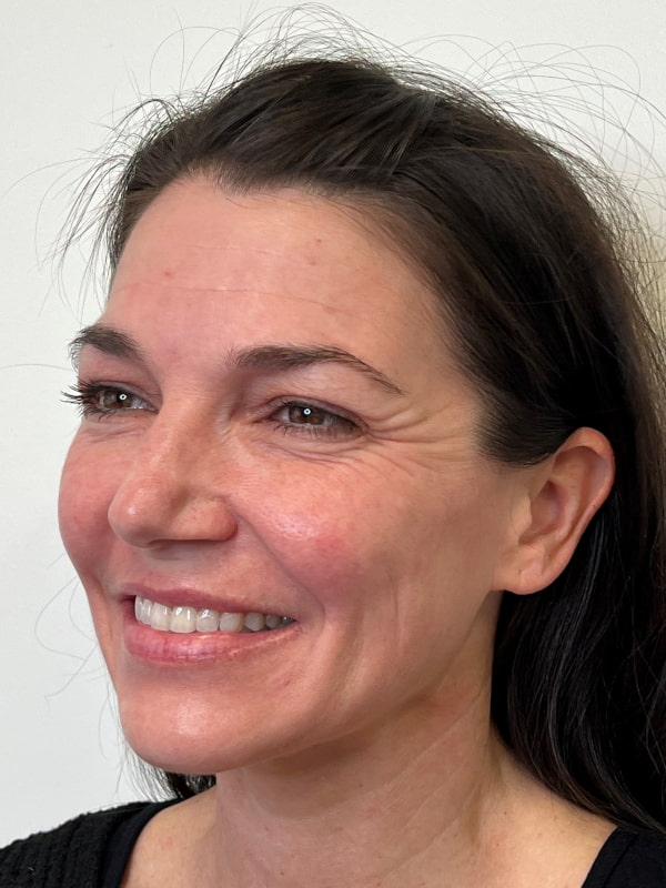 Botox/Dysport Before & After Image