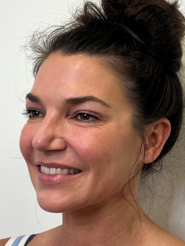 Botox/Dysport Before & After Image