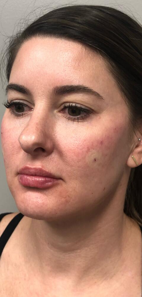 Cheek Filler Before & After Image