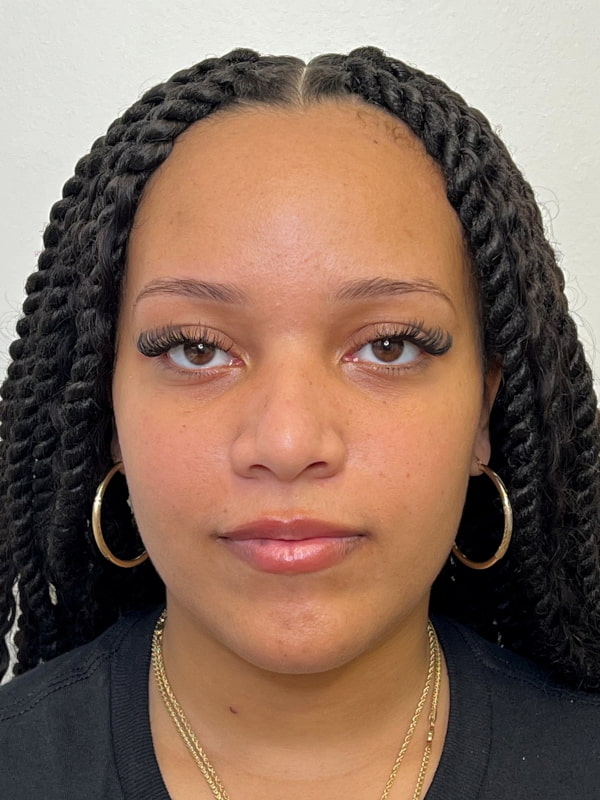 Cheek Filler Before & After Image