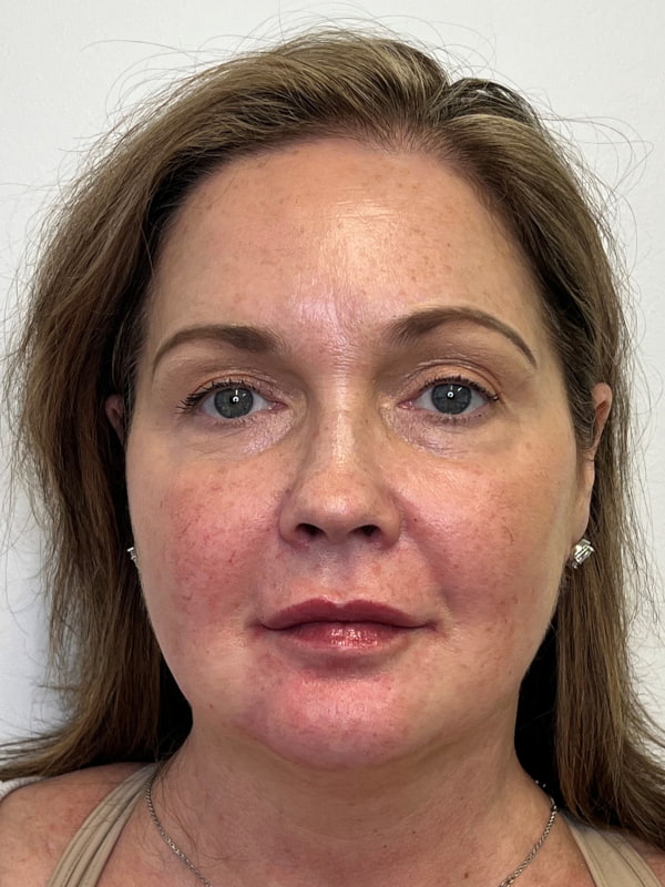 Cheek Filler Before & After Image