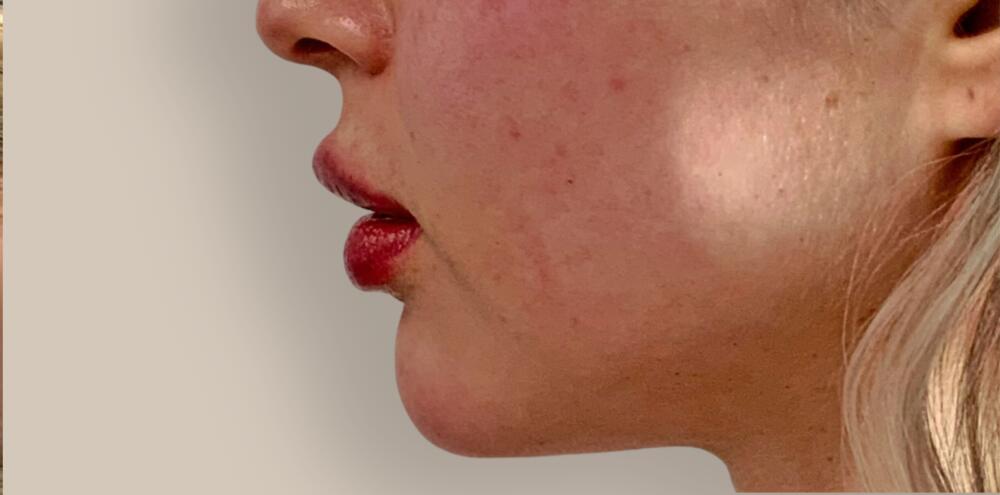 Chin Filler Before & After Image