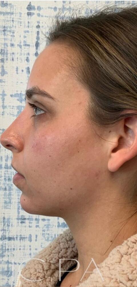 Chin Filler Before & After Image