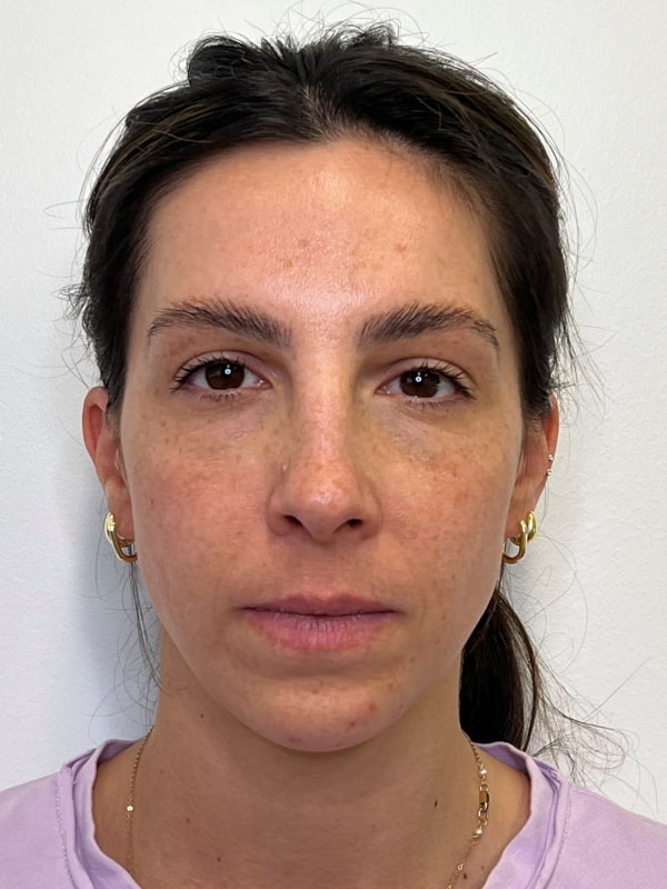 Chin Filler Before & After Image