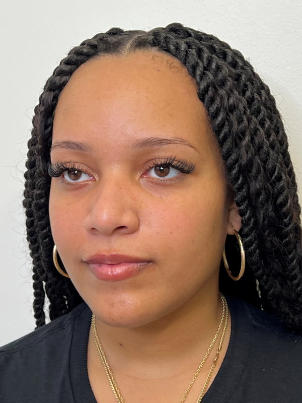 Chin Filler Before & After Image