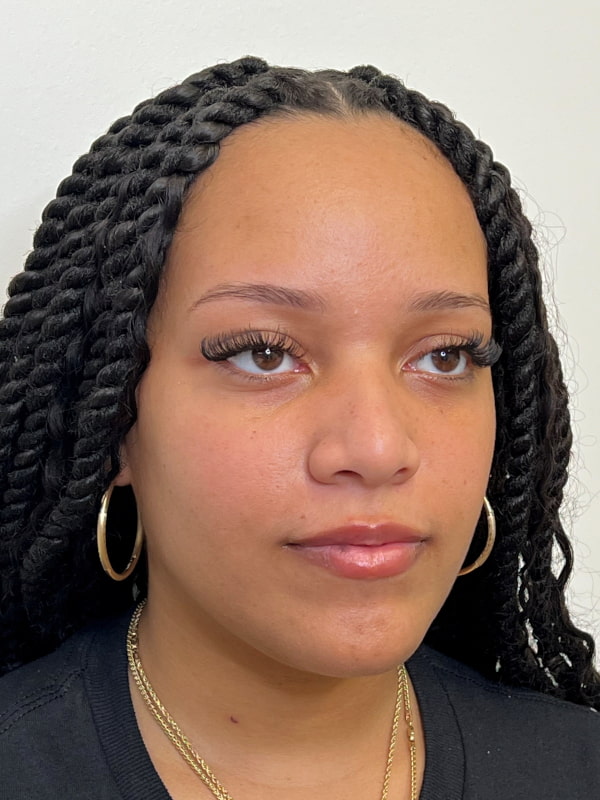 Chin Filler Before & After Image