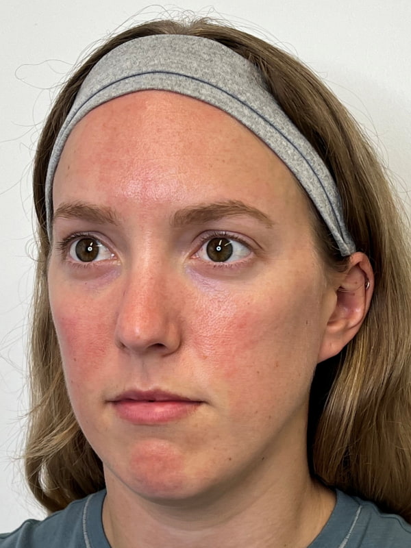 Chin Filler Before & After Image