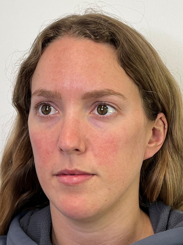 Chin Filler Before & After Image