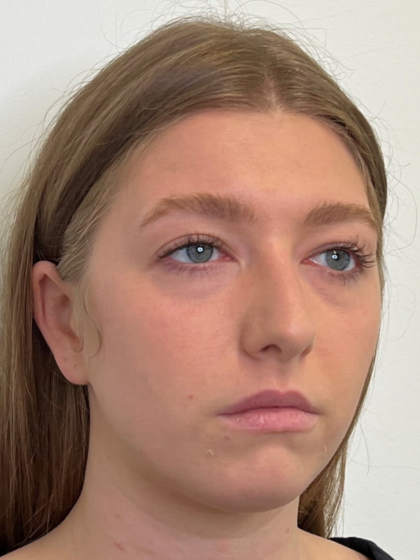 Chin Filler Before & After Image