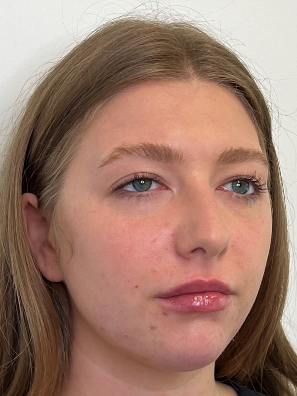 Chin Filler Before & After Image