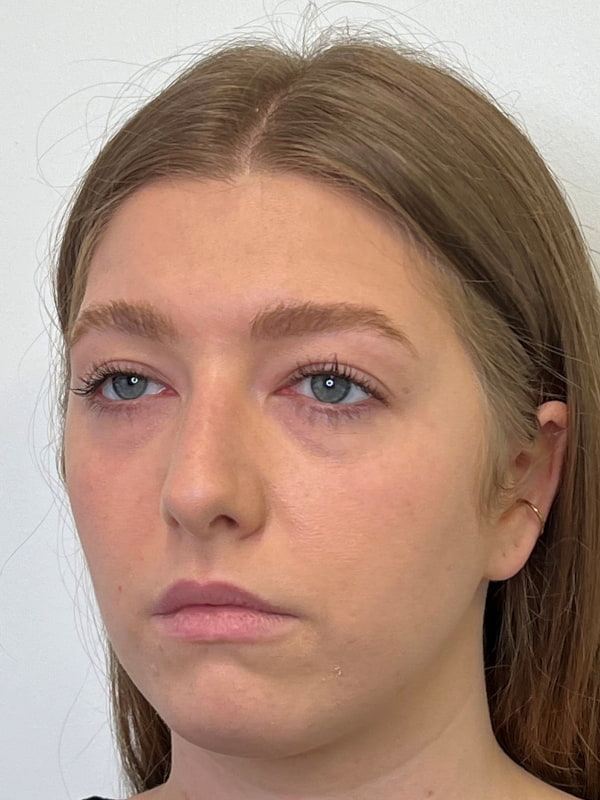 Chin Filler Before & After Image