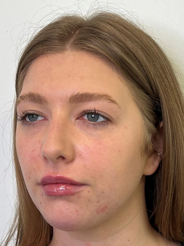Chin Filler Before & After Image