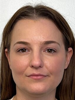 Chin Filler Before & After Image