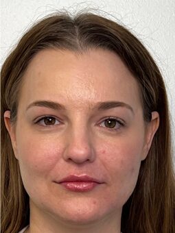 Chin Filler Before & After Image