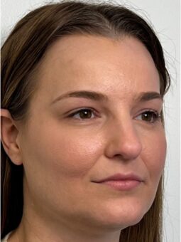 Chin Filler Before & After Image