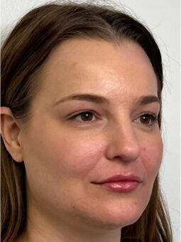 Chin Filler Before & After Image
