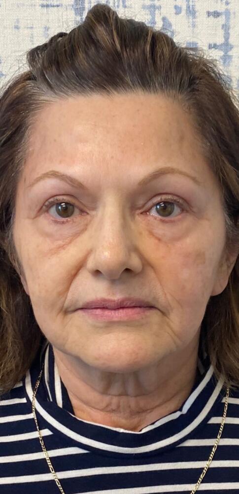 Facial Balancing Before & After Image