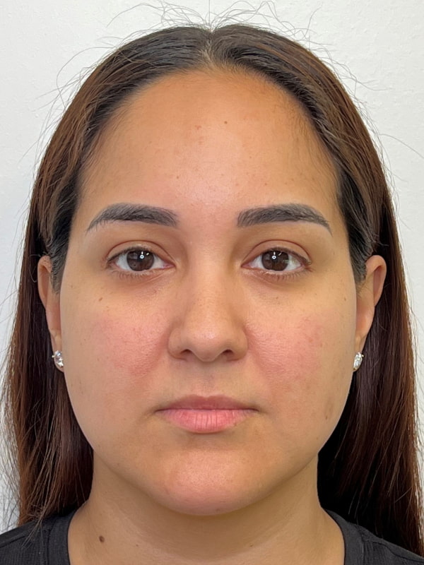 Facial Balancing Before & After Image