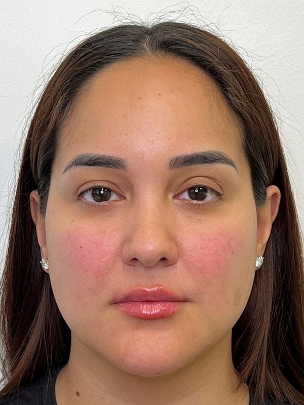 Facial Balancing Before & After Image