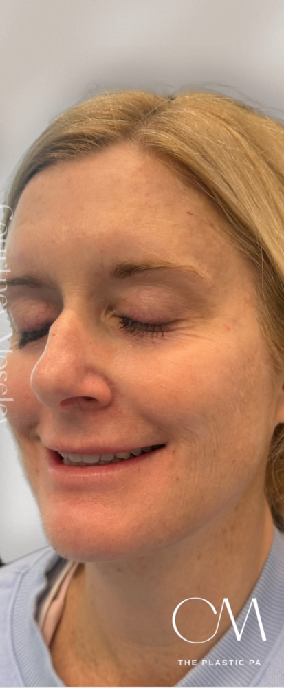 Facial Balancing Before & After Image