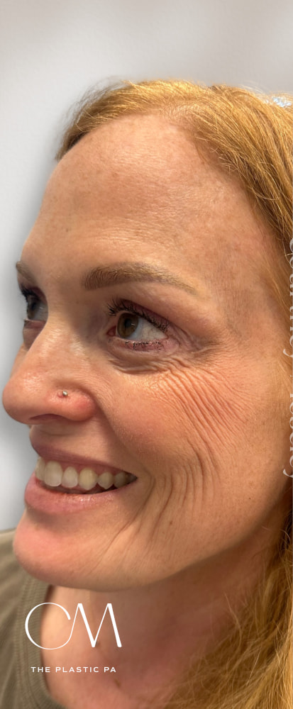 Facial Balancing Before & After Image