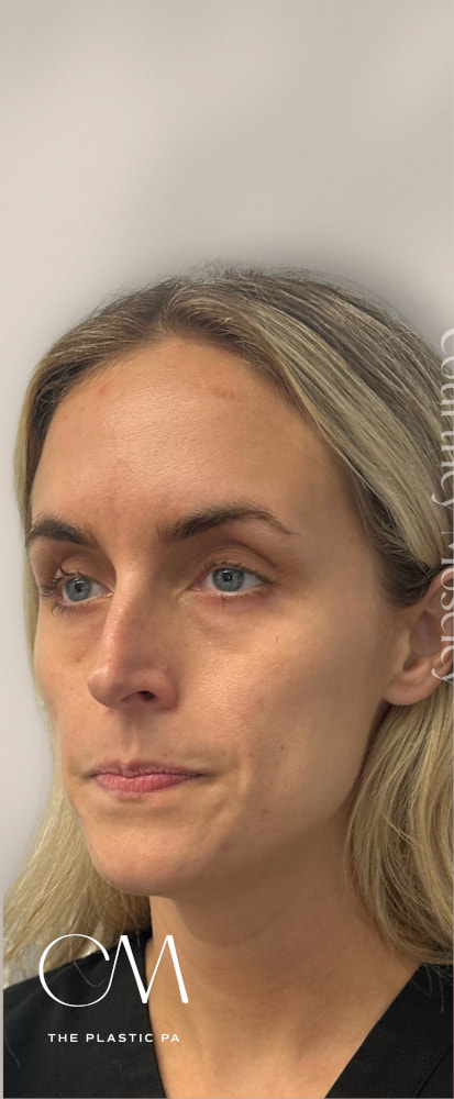 Facial Balancing Before & After Image