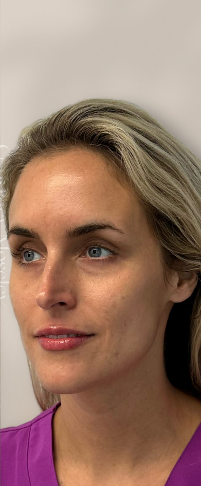 Facial Balancing Before & After Image