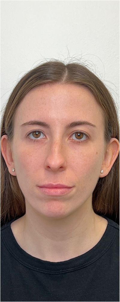Facial Balancing Before & After Image