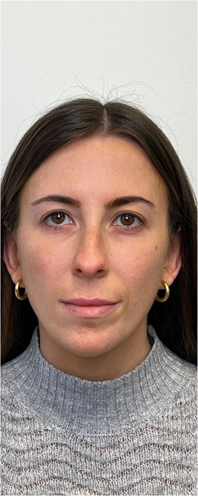 Facial Balancing Before & After Image