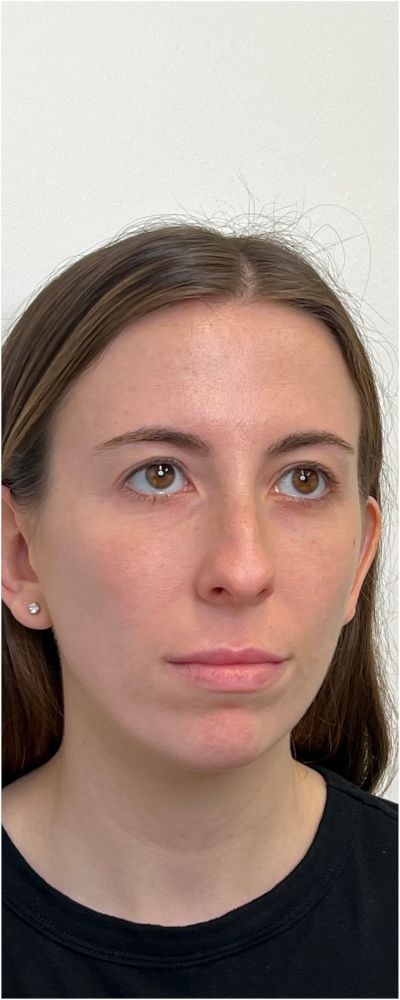 Facial Balancing Before & After Image