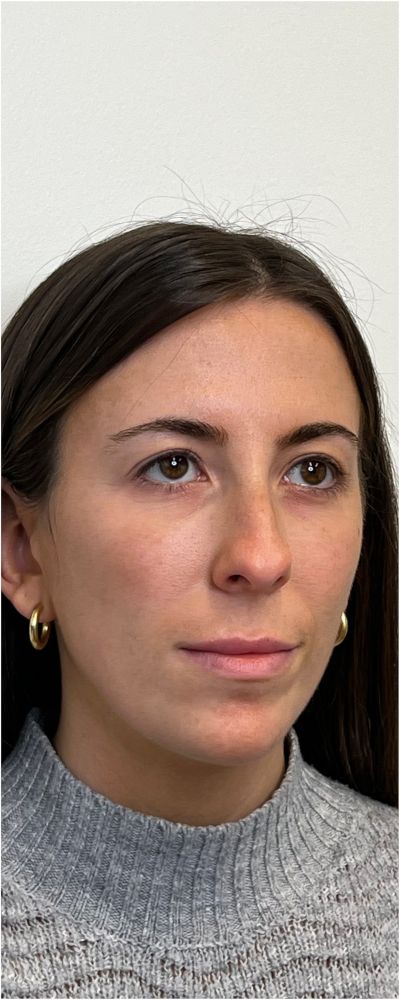 Facial Balancing Before & After Image