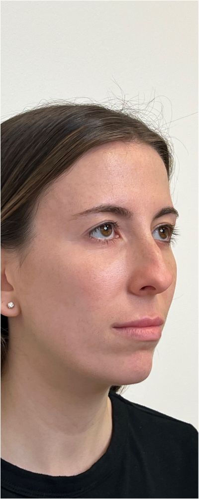 Facial Balancing Before & After Image