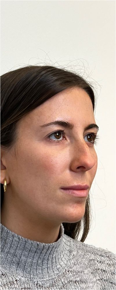 Facial Balancing Before & After Image