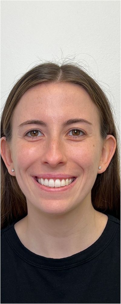 Facial Balancing Before & After Image