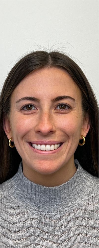 Facial Balancing Before & After Image