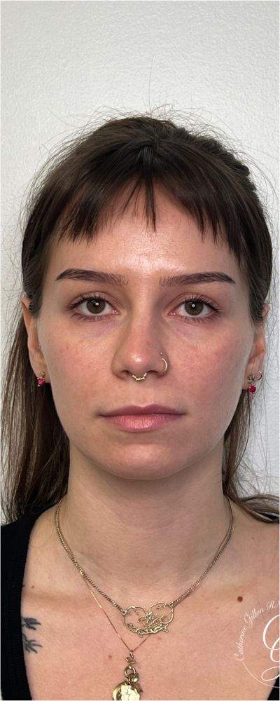 Facial Balancing Before & After Image