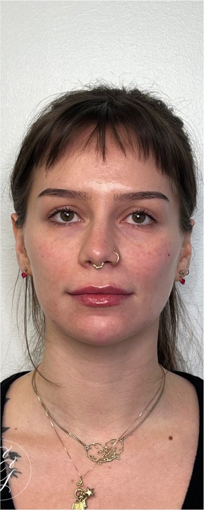 Facial Balancing Before & After Image