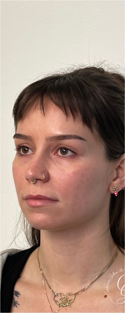Facial Balancing Before & After Image
