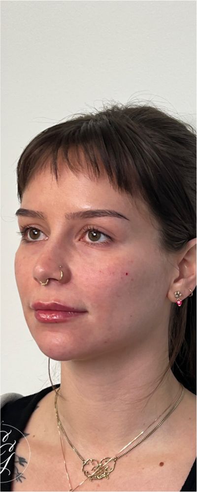 Facial Balancing Before & After Image