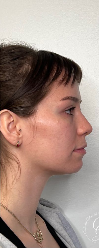 Facial Balancing Before & After Image