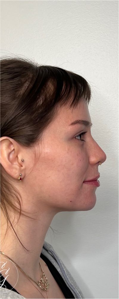Facial Balancing Before & After Image