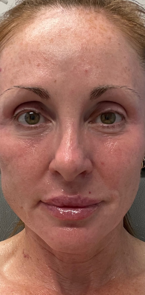 Laser Rejuvenation Before & After Image