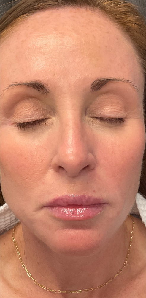 Laser Rejuvenation Before & After Image