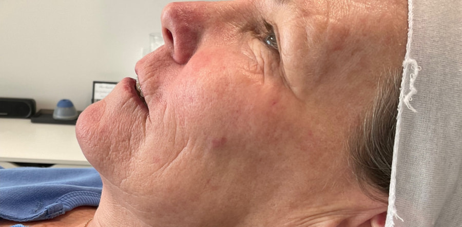 Laser Rejuvenation Before & After Image