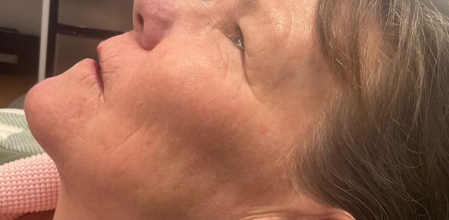 Laser Rejuvenation Before & After Image